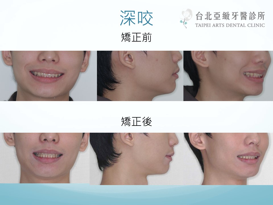 台北亞緻牙醫 牙齒矯正