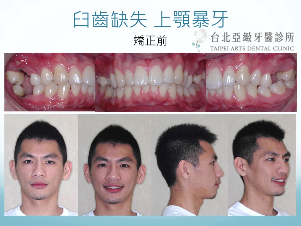  台北亞緻牙醫 正顎手術 矯正