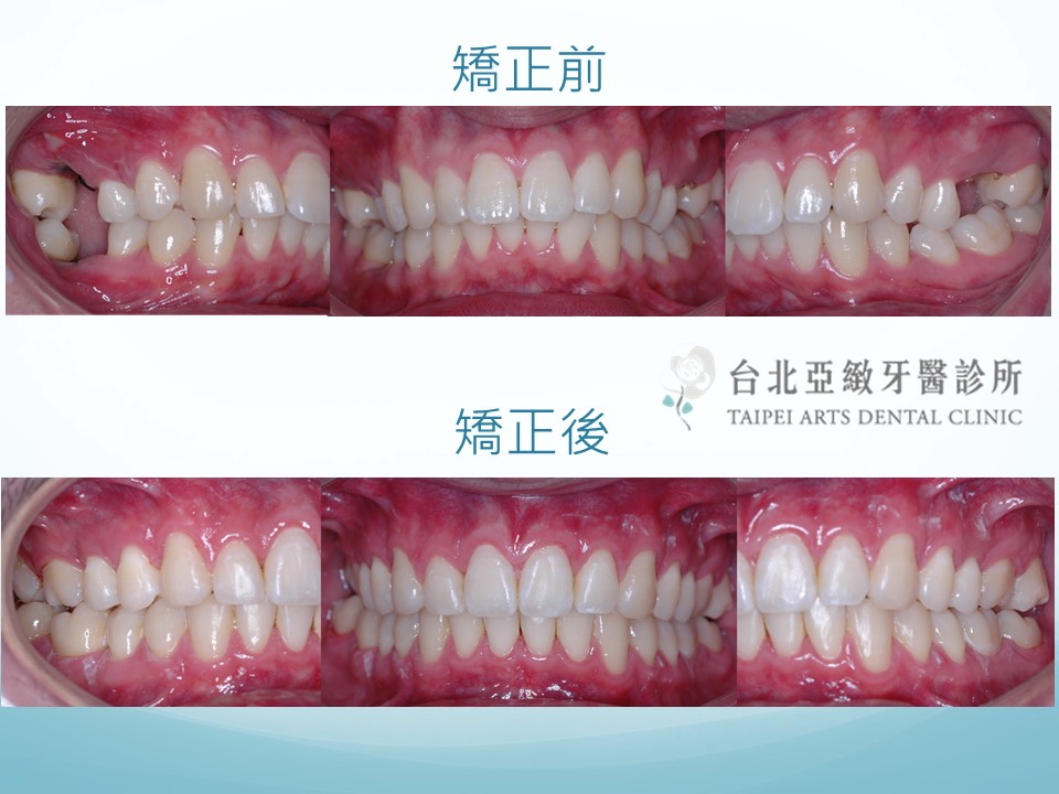 牙齒矯正 台北亞緻牙醫