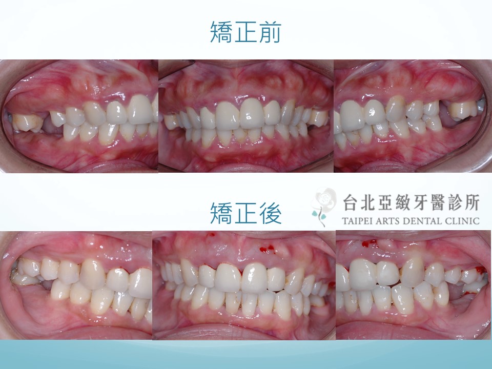牙齒矯正 台北亞緻牙醫  正顎手術 