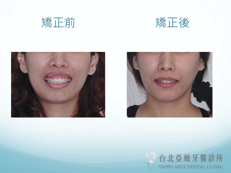 正顎手術 矯正 台北亞緻牙醫 