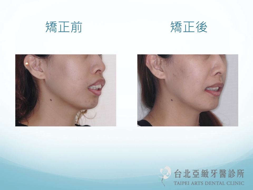 台北亞緻牙醫 正顎手術