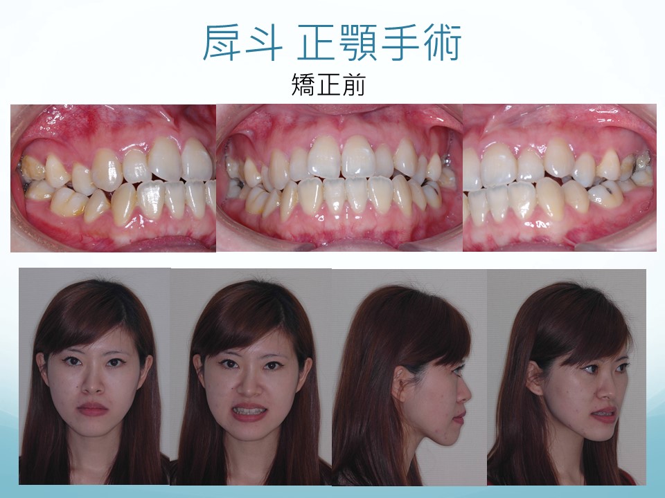 台北亞緻牙醫  正顎手術 矯正 