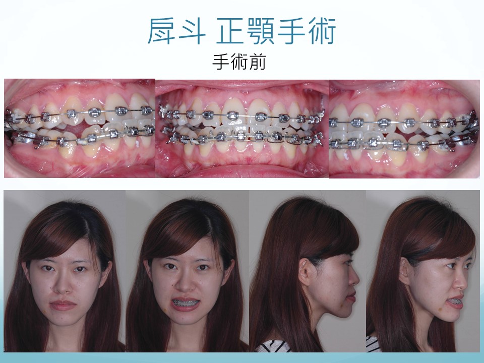 正顎手術 矯正 台北亞緻牙醫 