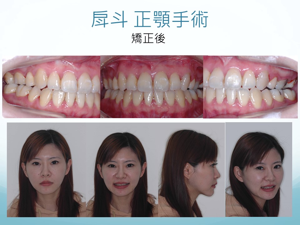 正顎手術 牙齒矯正 台北亞緻牙醫