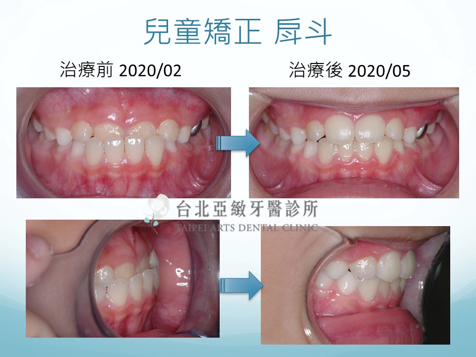 台北亞緻牙醫 戽斗矯正牙齒 