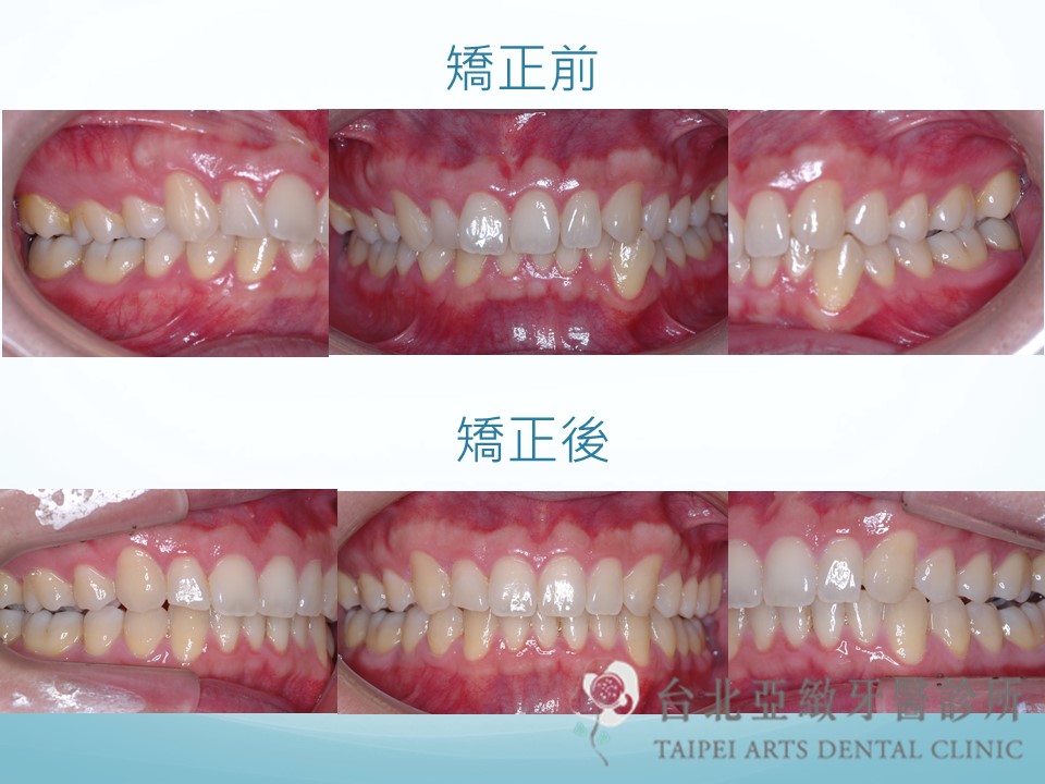 台北亞緻牙醫 隱士美牙齒矯正 